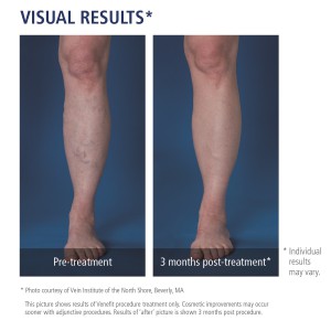 Before and After Treatment for Varicose Veins