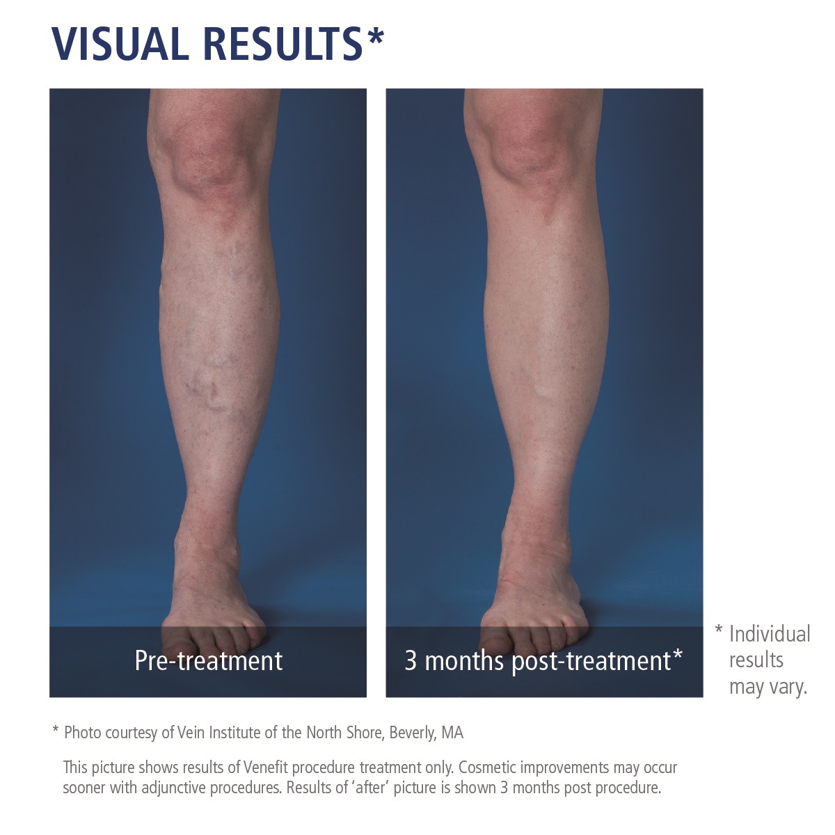 Varicose Veins & Chronic Venous Insufficiency treated gently